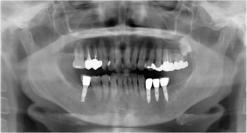 金原３　上部構造の装着